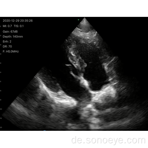 Pocketyp Phased Array Color Doppler Ultraschall